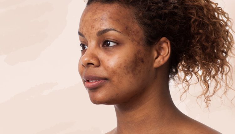 4 natural ways to get rid of pimples as fast as possible